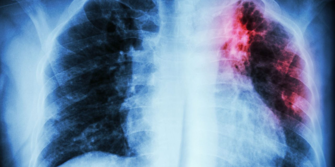 Breaking the cycle: how South Africa can overcome its TB challenge