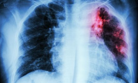 Breaking the cycle: how South Africa can overcome its TB challenge