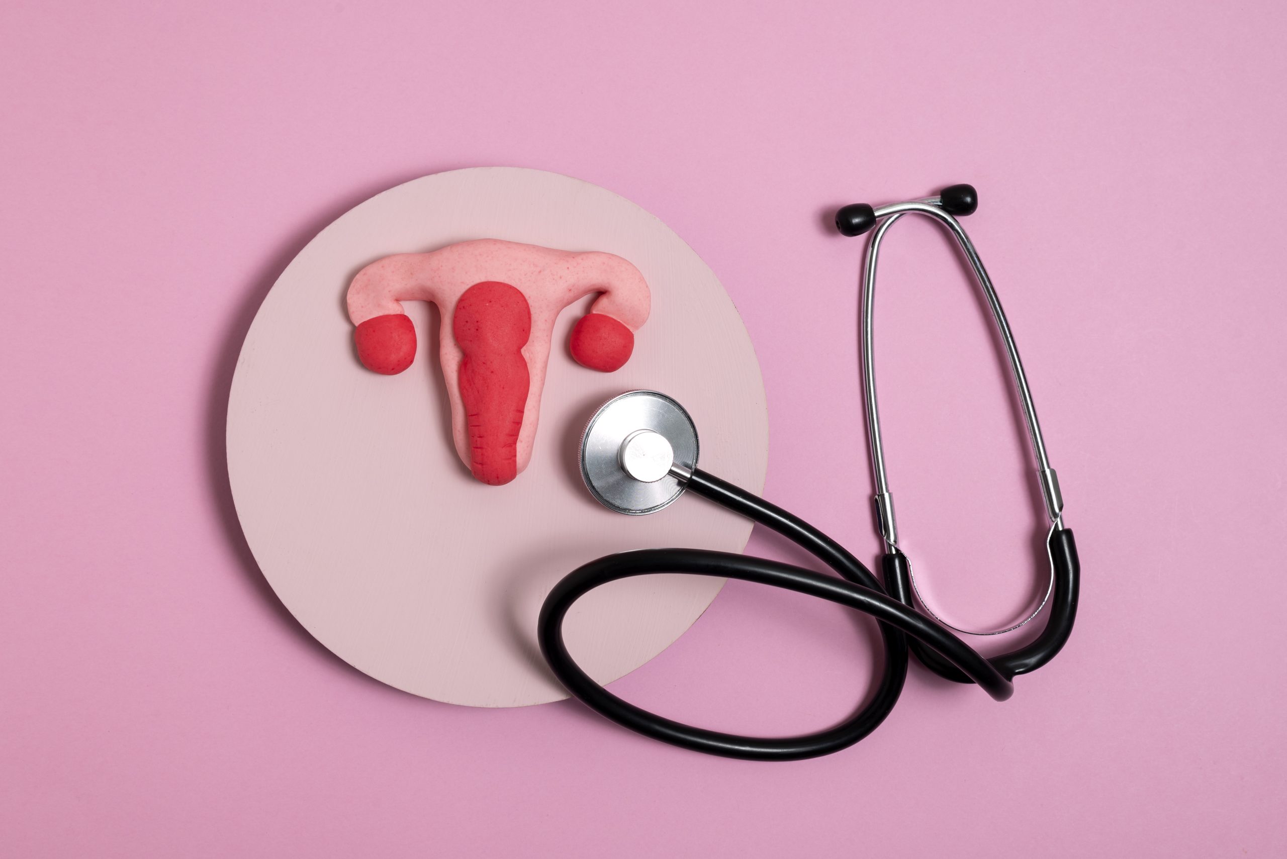 Managing PCOS