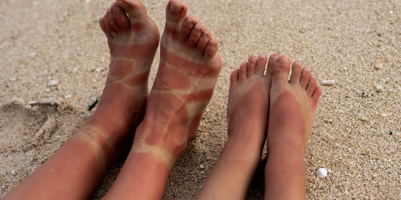 Burnt or irritated skin? Try these first aid and natural remedies